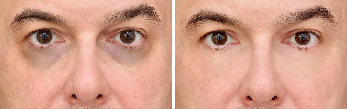 Puffy Eyes: Symptoms, Causes, and How to Get Rid of Them