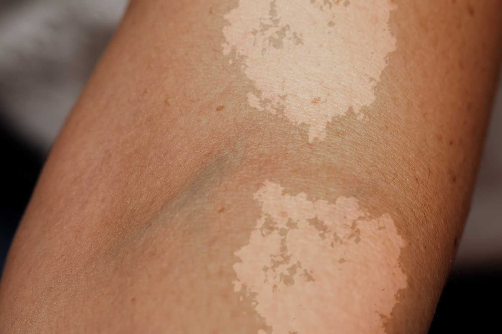 http://www.stryx.com/cdn/shop/articles/how-to-get-rid-of-skin-discoloration.jpg?v=1605086320